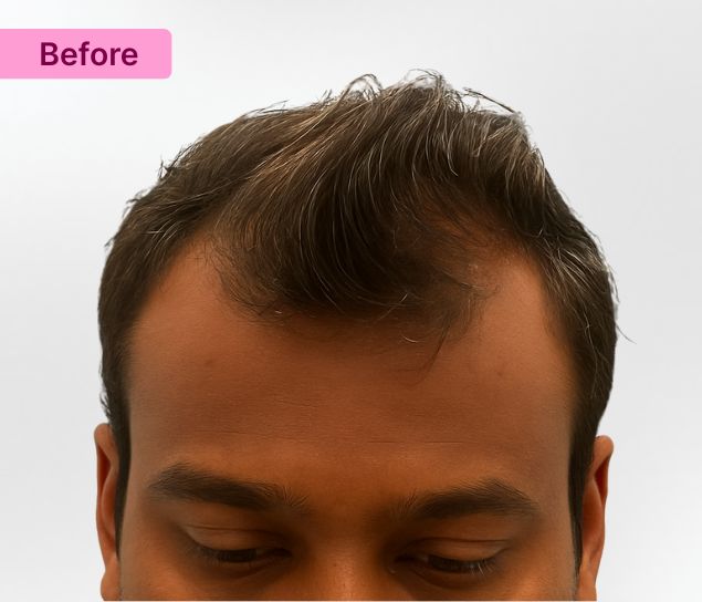 Hair Transplant Results