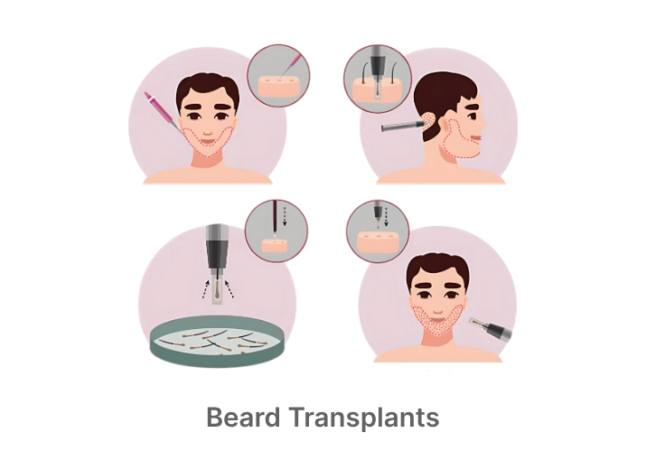 Beard Transplants