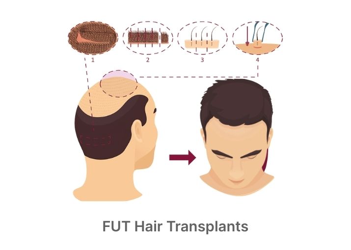 High-Density FUT Hair Transplants at HairGroww