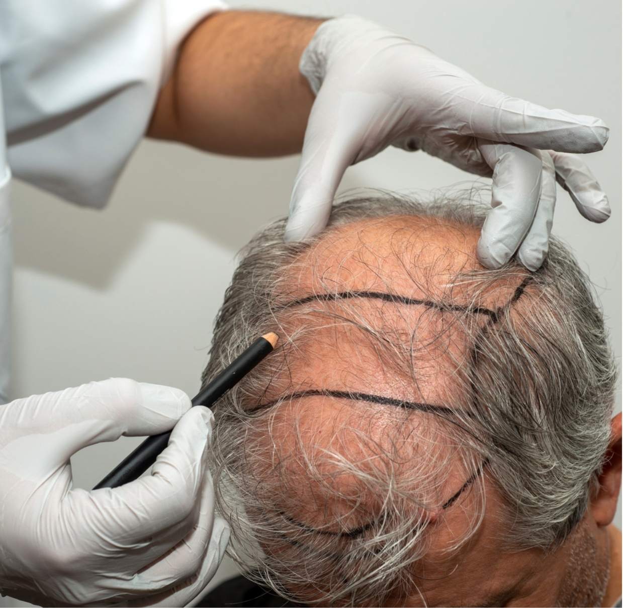 Hair Transplant Services at Hairgroww
